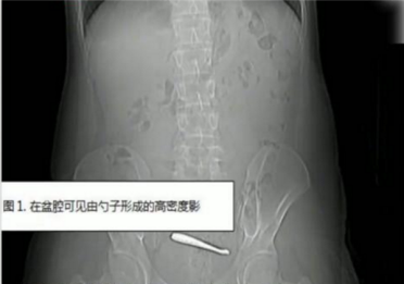 瞠目结舌：南京一小伙腹痛CT查出肠道卡2把勺子 直言吞下时没察觉