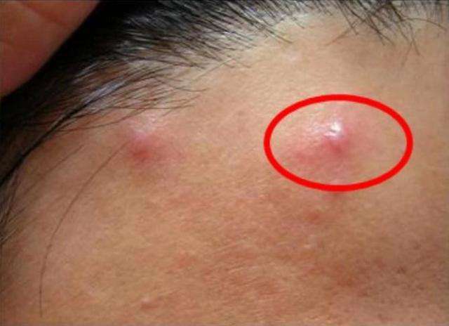 为什么痘痘硬硬的?要多久能好?
