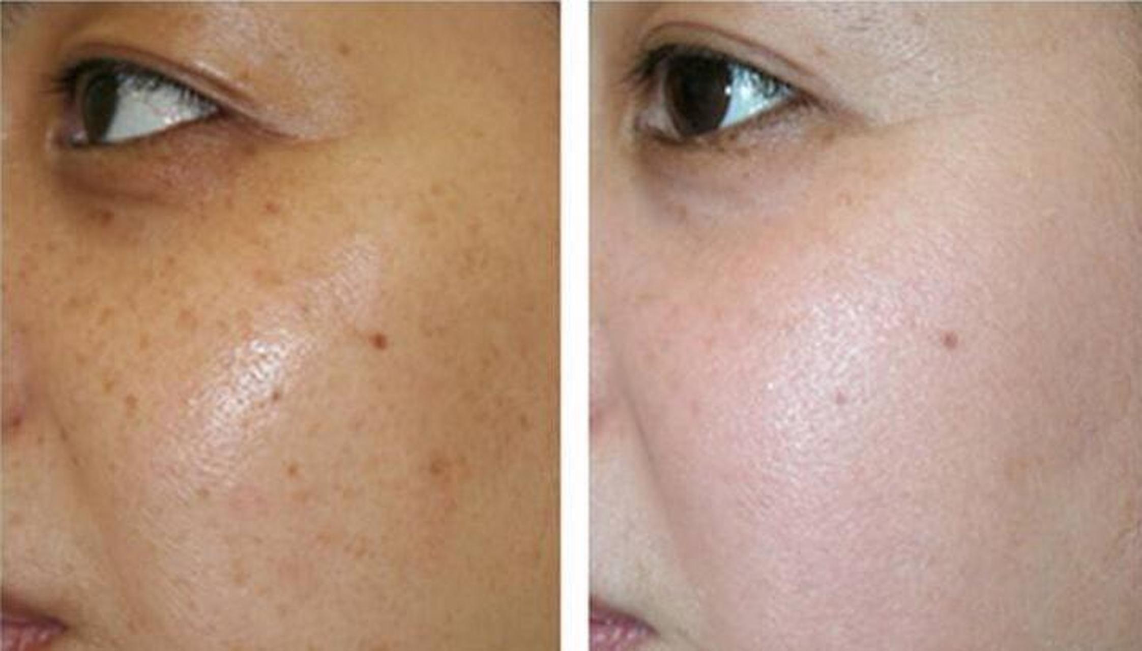 肝毒深,4种丑态藏都藏不住 1,脸色暗沉 皮肤发黄暗沉,而且分布不均匀