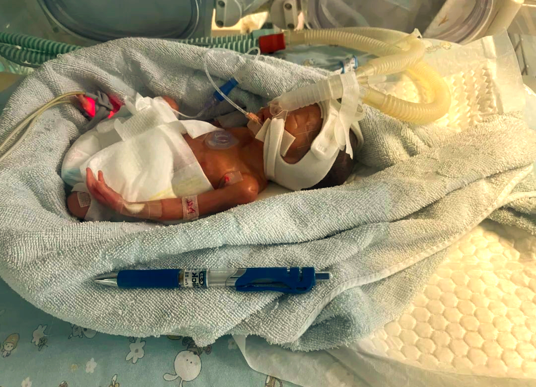 超早产儿小石头:医护团队创造生命奇迹