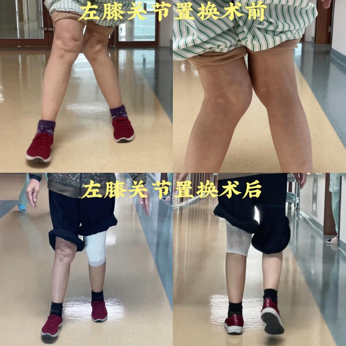 78岁珠海老人膝关节畸形成k型腿 ai 3d打印技术助力复原