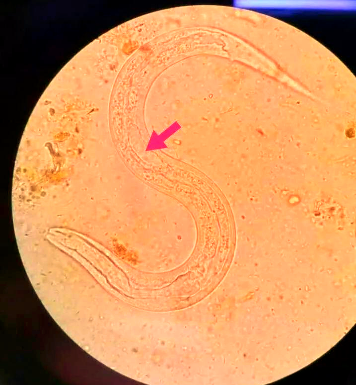 粪类圆线虫与钩虫幼虫的鉴别全攻略