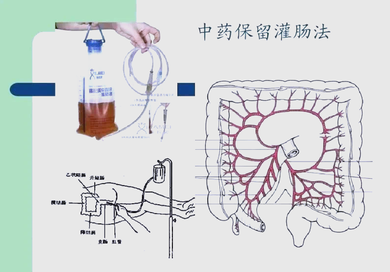 中药灌肠:妇科治疗的绿色新选择与安全性分析