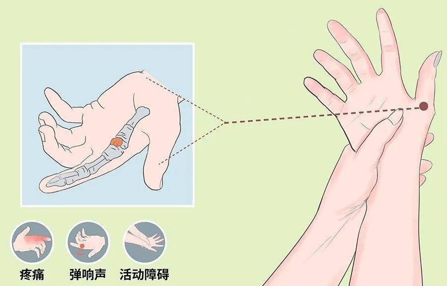 腱鞘炎症状治疗方法图片