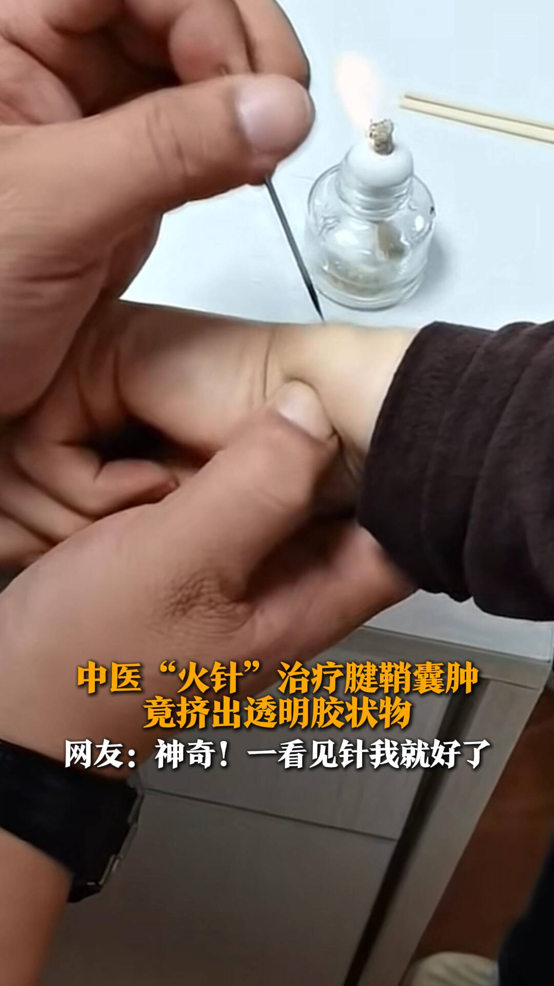 中医"火针"治疗腱鞘囊肿 竟挤出透明胶状物 网友:神奇!