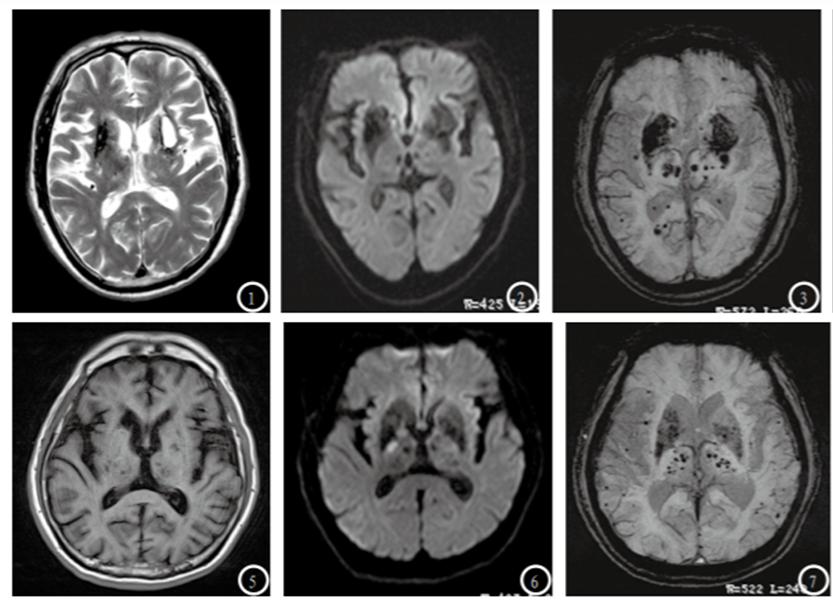 脑出血磁共振图片图片