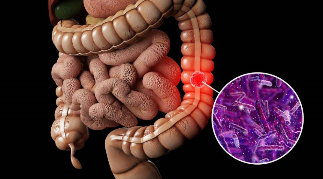 腸癌或許不能拖!腫瘤專家:大便出現這些異常,儘量不要輕視