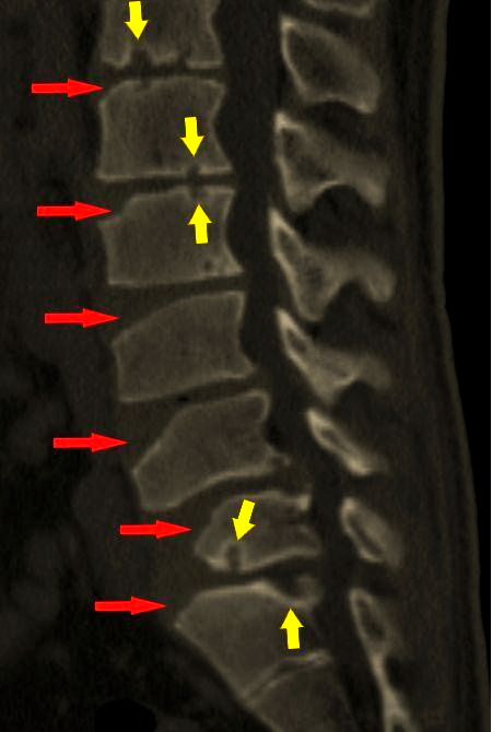 青少年驼背的病因与影像研究:休门氏病的深度解析