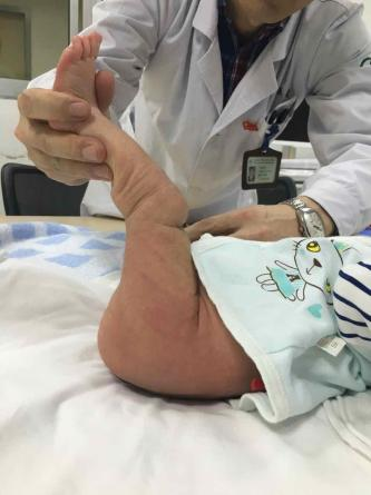 破解疑难罕见病 | 新生宝宝膝盖"长反了"……原来这是一种先天性疾病