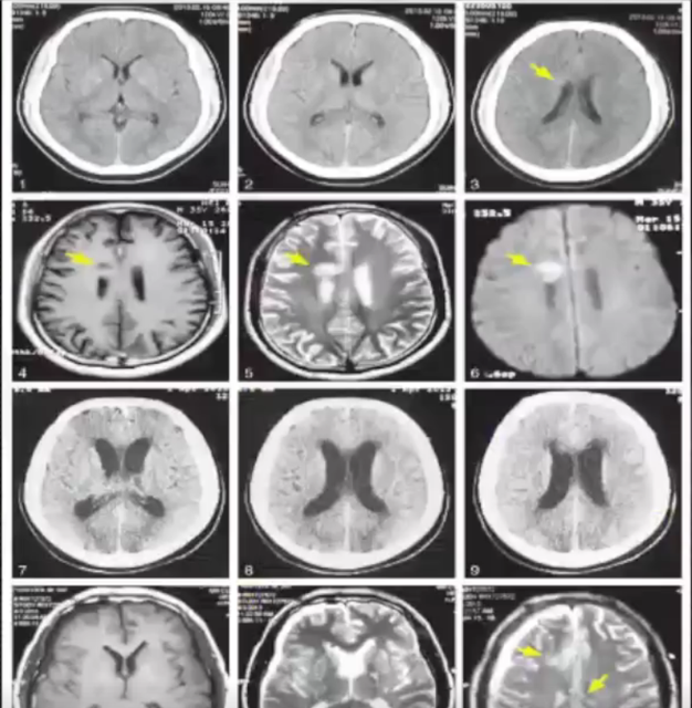 脑梗塞核磁图片图片