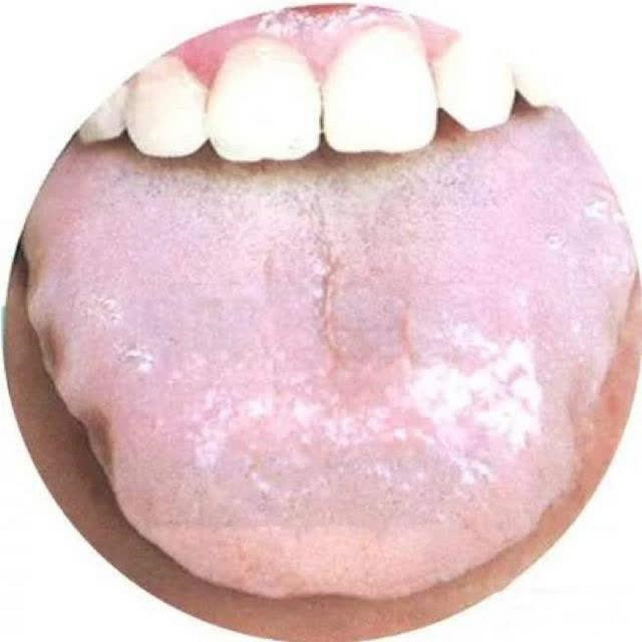 脾虚湿气重,3种常见舌象,对照自测 1,气虚(脾虚)型——舌体胖大,舌边