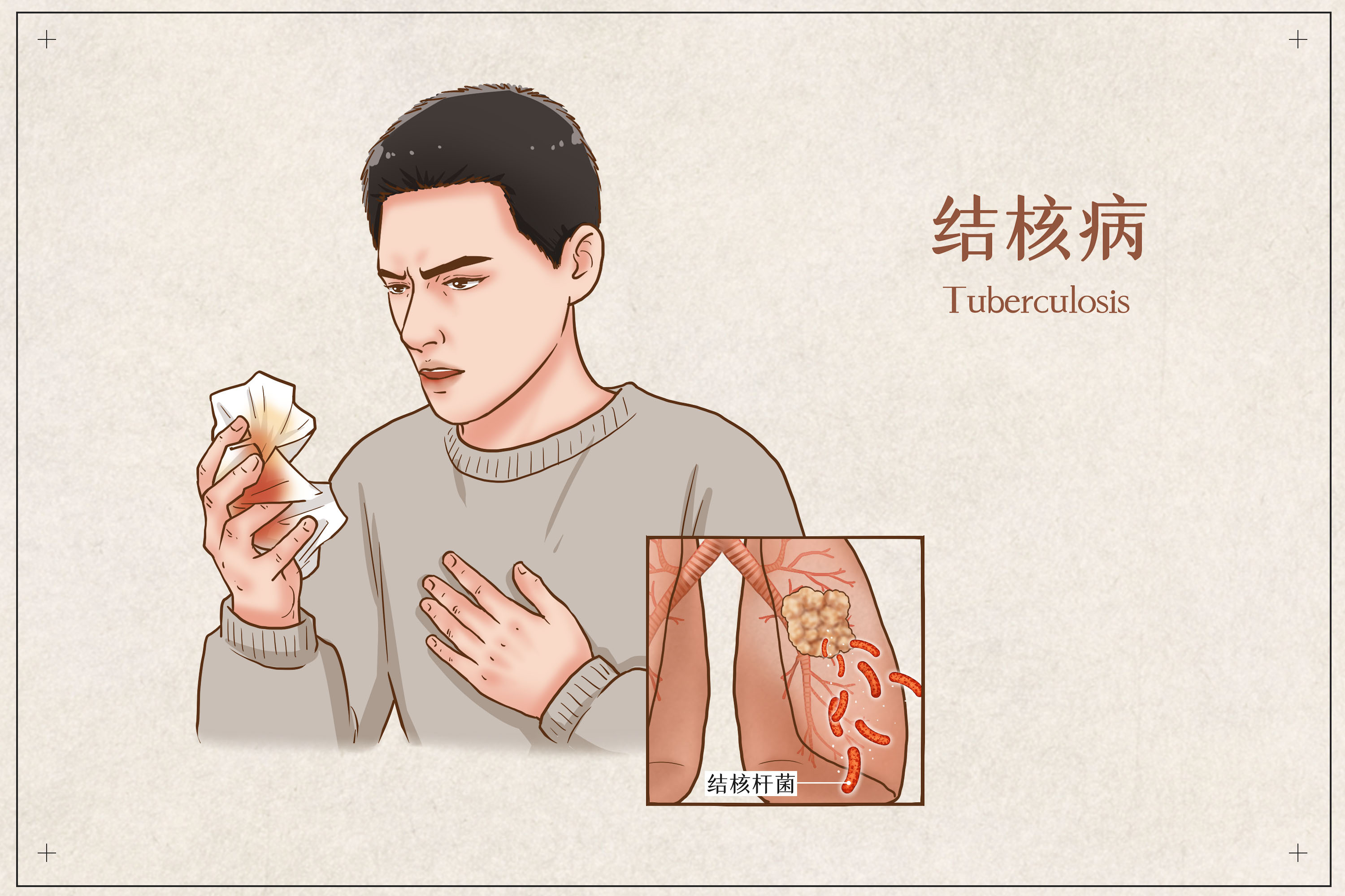 活动性肺结核图片