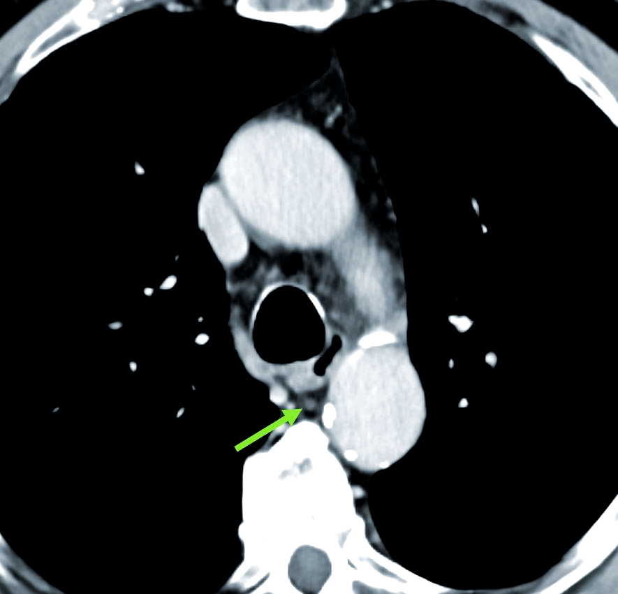 胸导管及其淋巴囊肿的ct影像特征详解