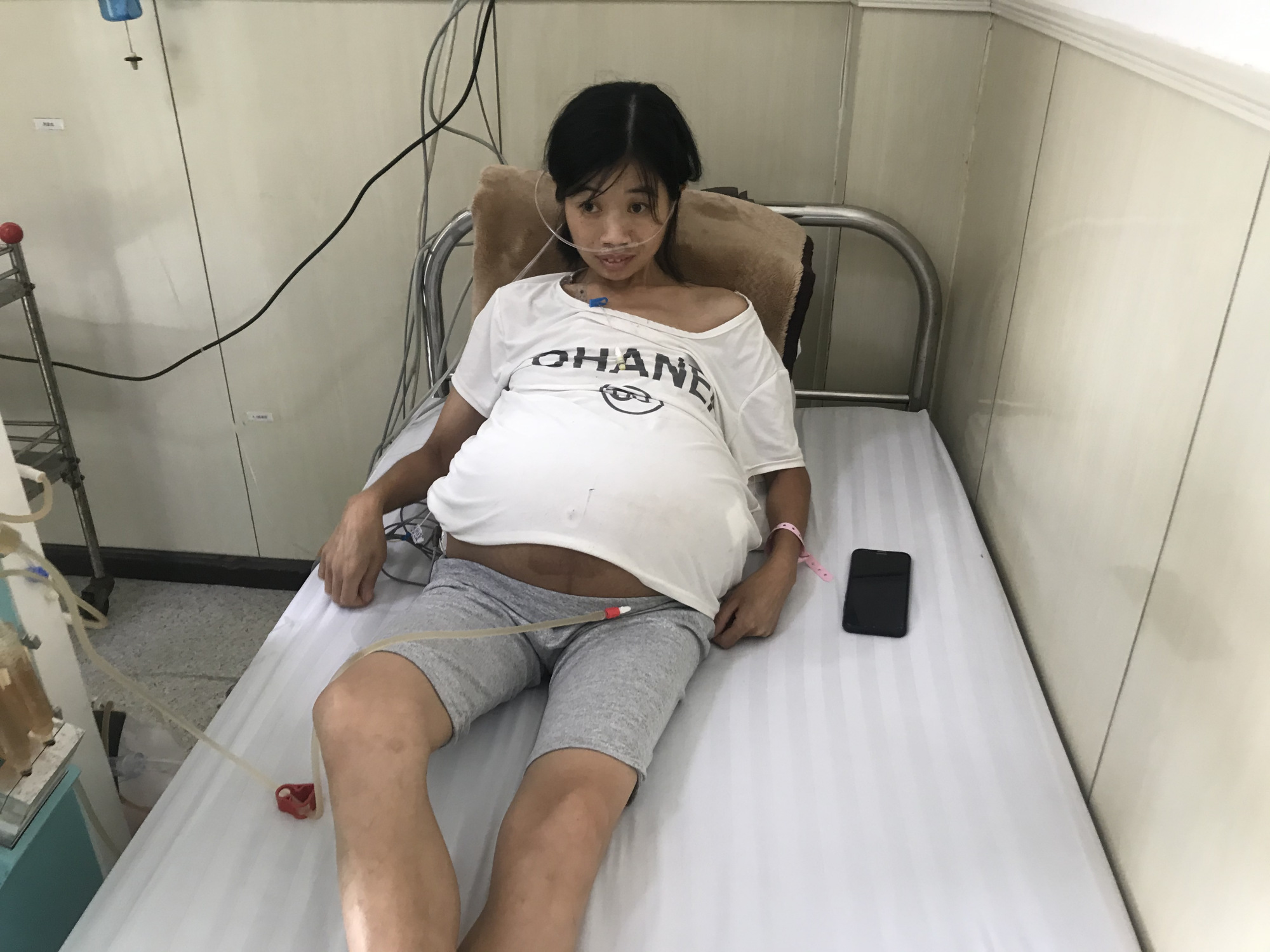 "巨肚母亲"病情有了新进展:第一期化疗结束,体重减掉56斤