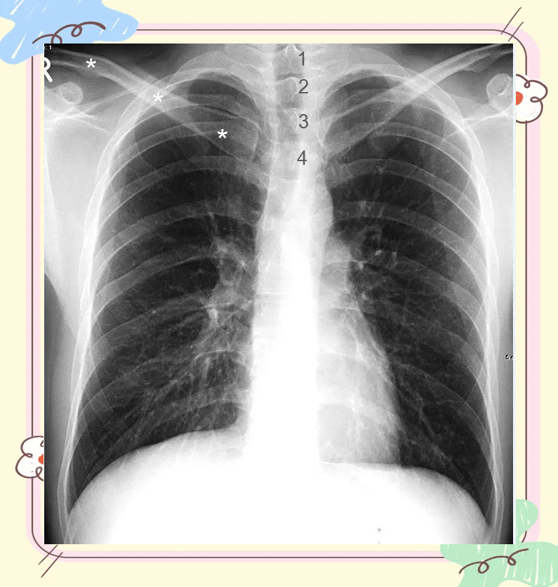 x线入门|正常胸片的分析与解读方法