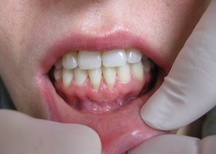 为什么会出现牙龈萎缩?5个原因,看看你中招了吗
