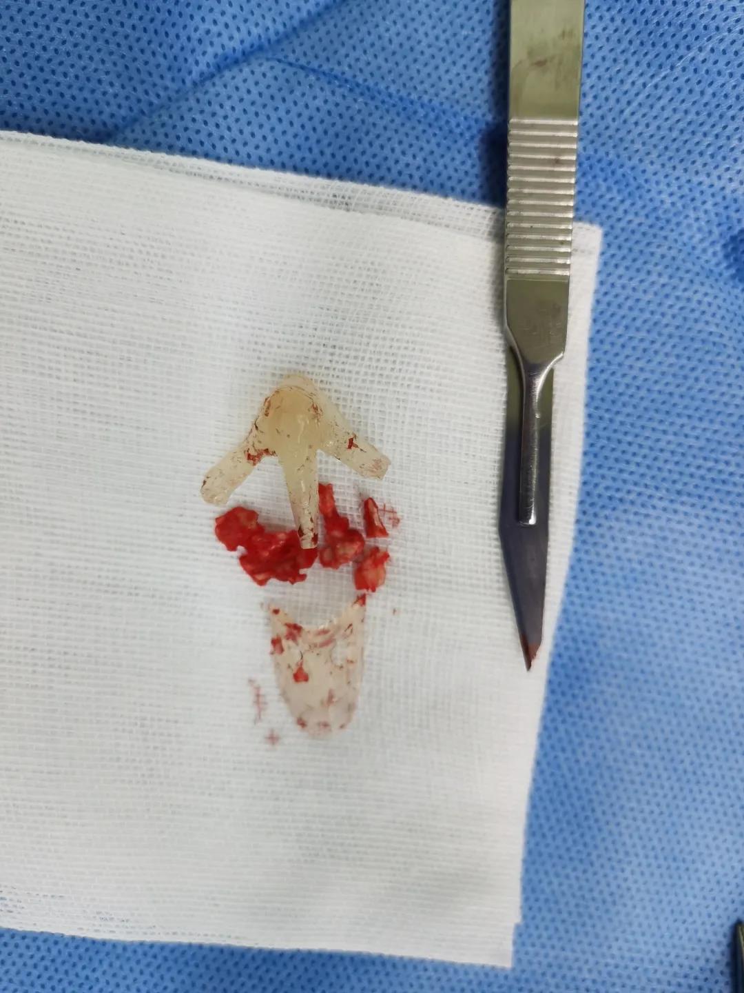 九院韦敏日常,两例"古董级"硅胶假体成功取出