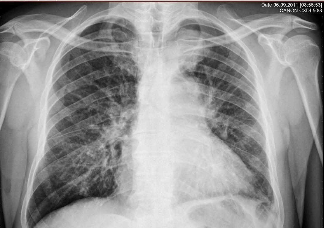 肺纹理增多严重吗?是什么病?怎么办?医生帮你解答清楚