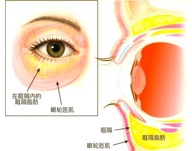 眼袋为何显老?揭秘眼袋产生的真相与治疗方法