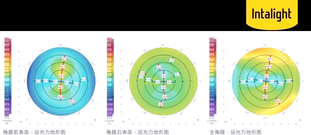 第2代可视化扫频生物测量技术:角膜全方位评估助力IOL优选