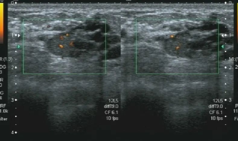 「病例分享」乳腺导管原位癌超声诊断一例