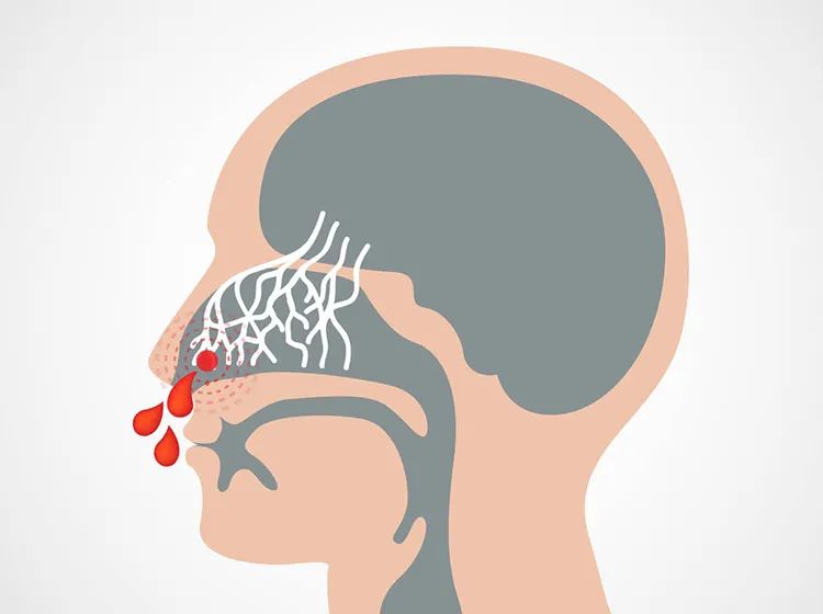 老人鼻出血別大意,一定警惕腦中風