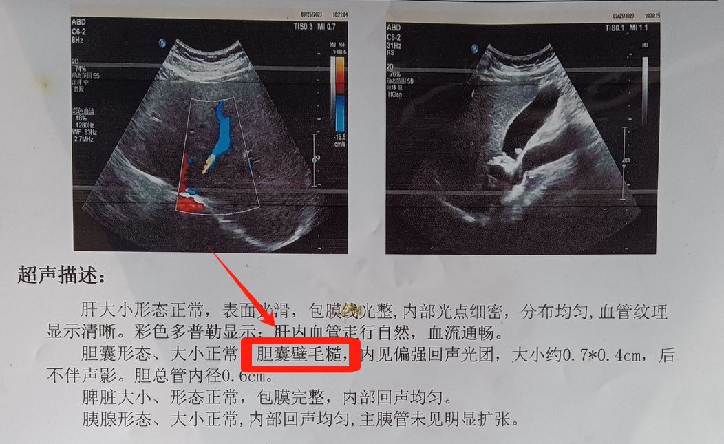 检查胆囊的时候,报告单上都会显示胆囊壁毛糙,那么胆囊壁毛糙是胆囊炎