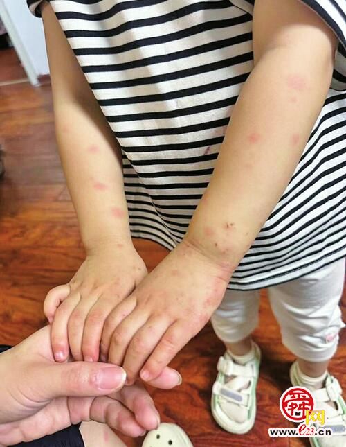 租房住一周,3岁孩子多次被床虱咬伤 中介承诺帮找新房源