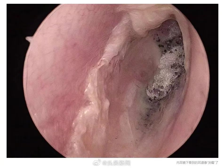 耳朵里长脚气千万别这样掏耳朵再爽也不行