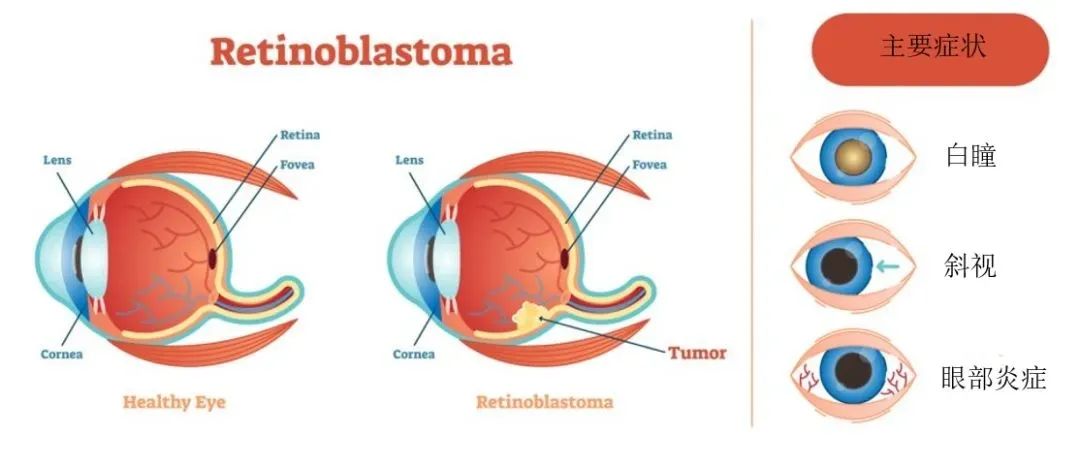 "猫眼"不可怕,这病可怕,我们让它不可怕!