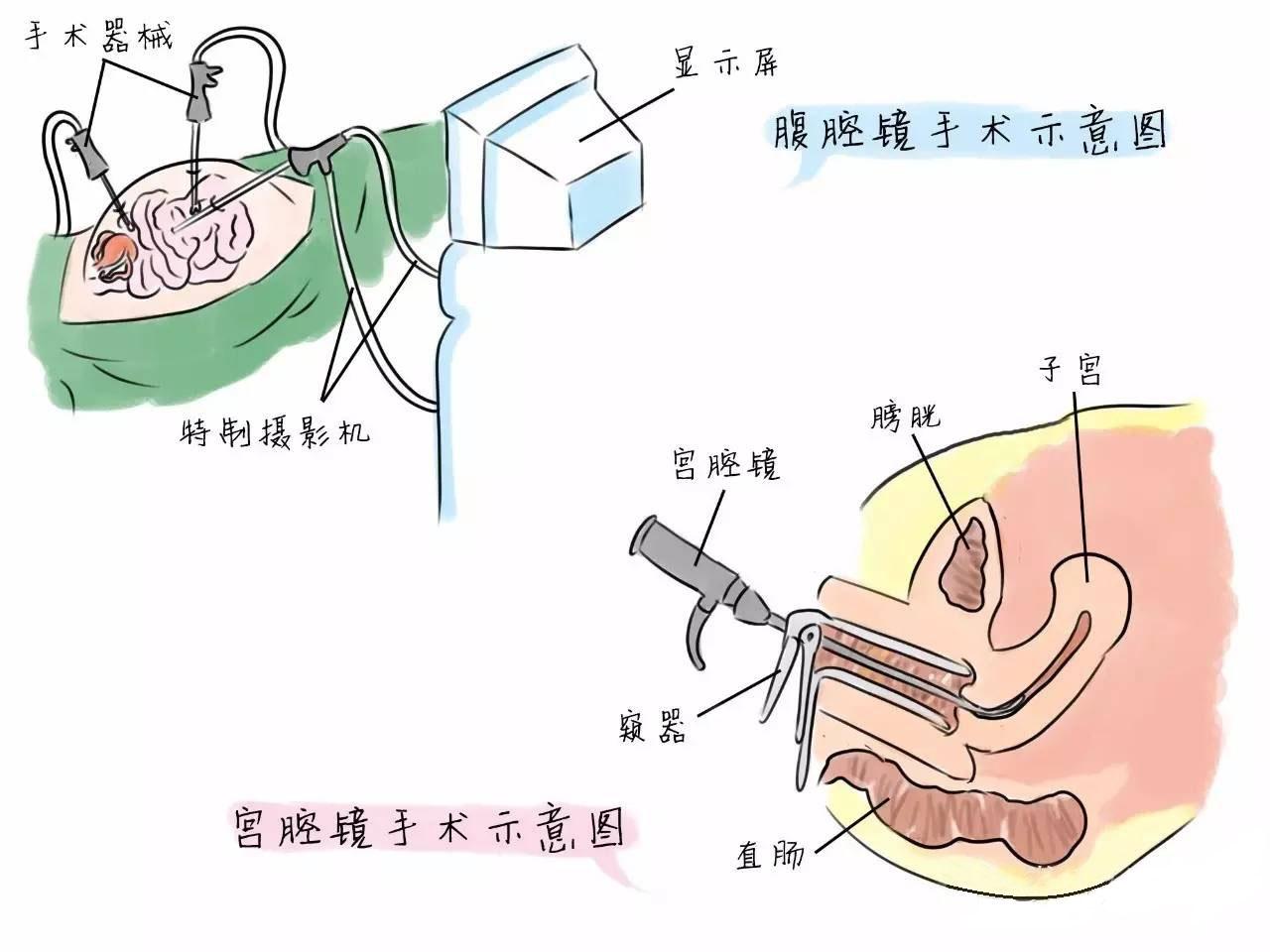 宫颈息肉有哪些症状