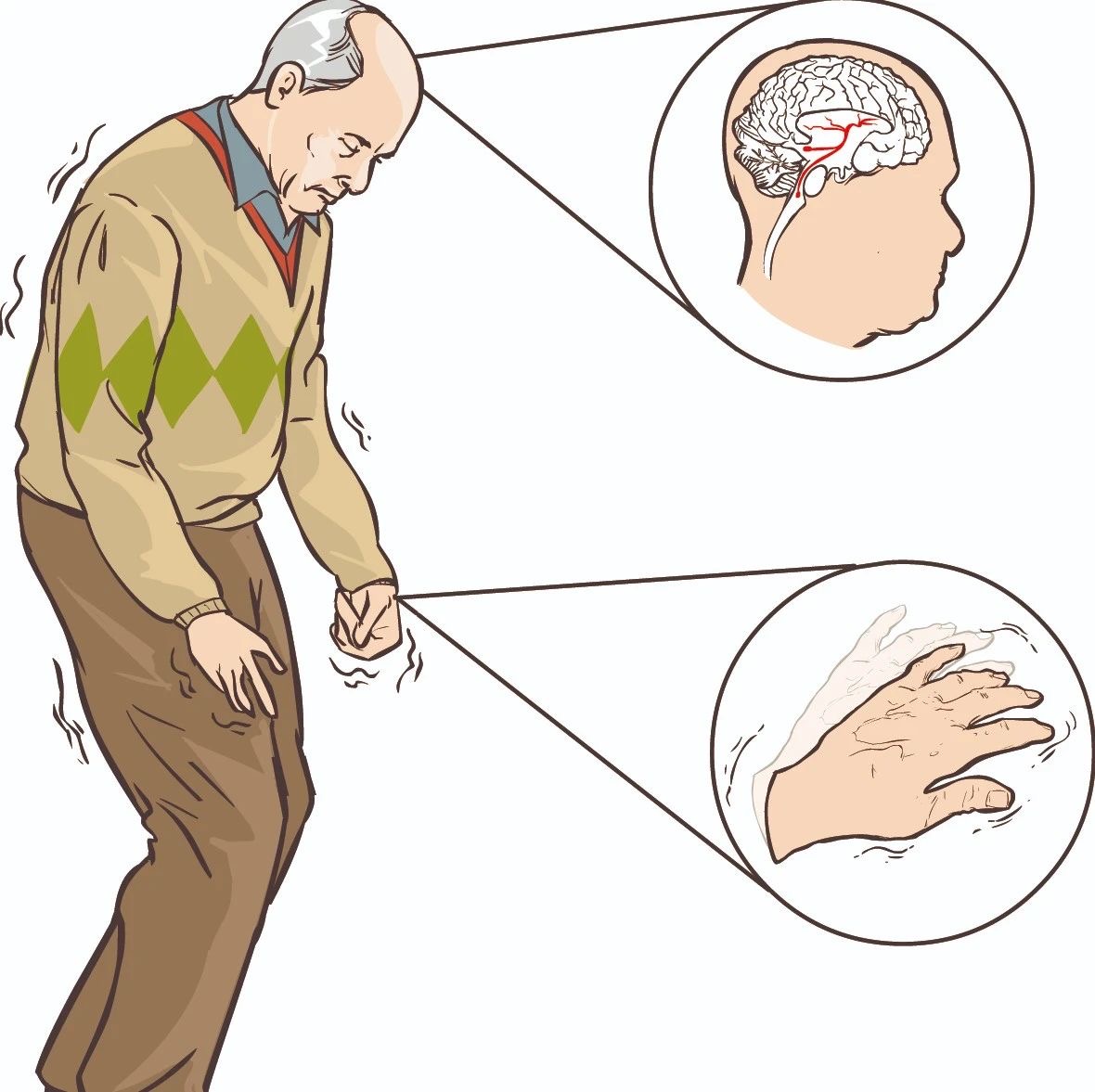 帕金森病患者如何保持身体活动和运动?