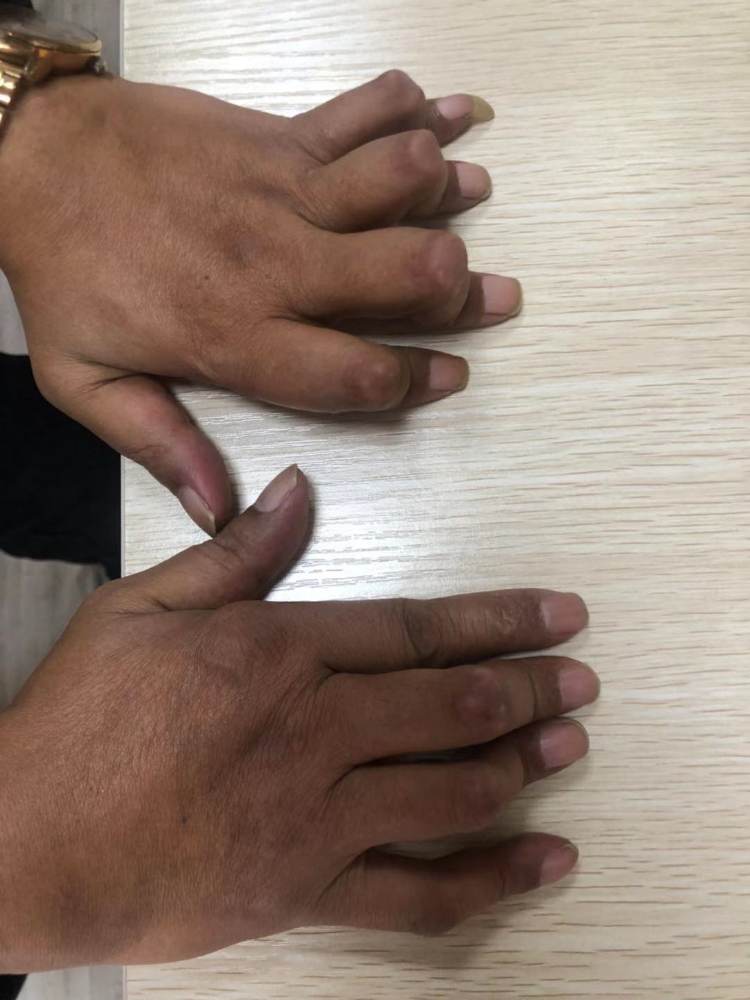 手指疼痛居然可能是类风湿引起的,看完这篇文章你就懂了