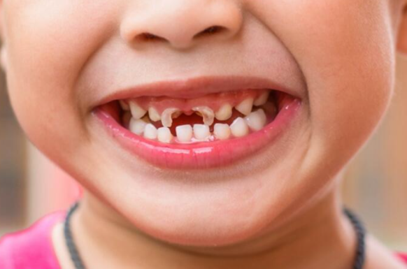 孙莉晒二女儿"豁牙照",儿童换牙顺序,怎么换,宝妈都知道吗?