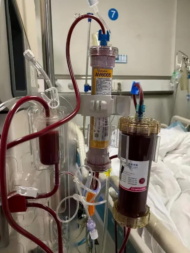 早期血浆置换出奶茶色液体