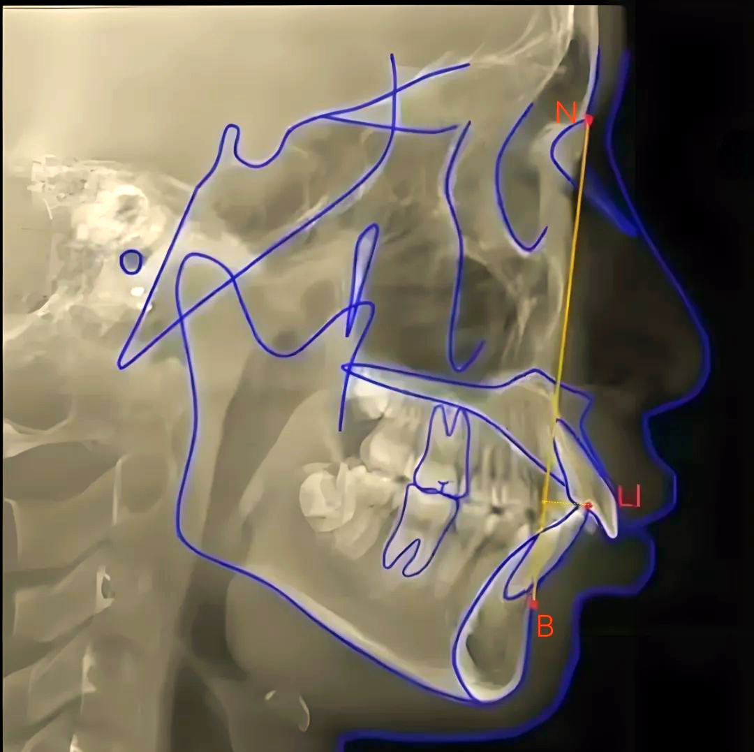 深入了解头影测量中的多种角度项目