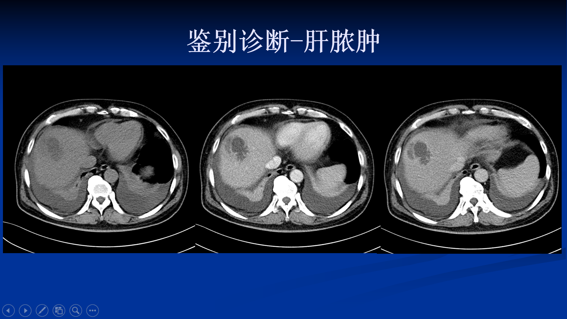 肝內膽管細胞癌ct及mri表現