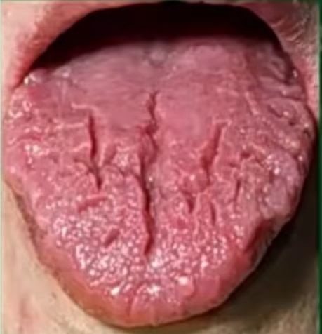舌头中间有一条沟图片