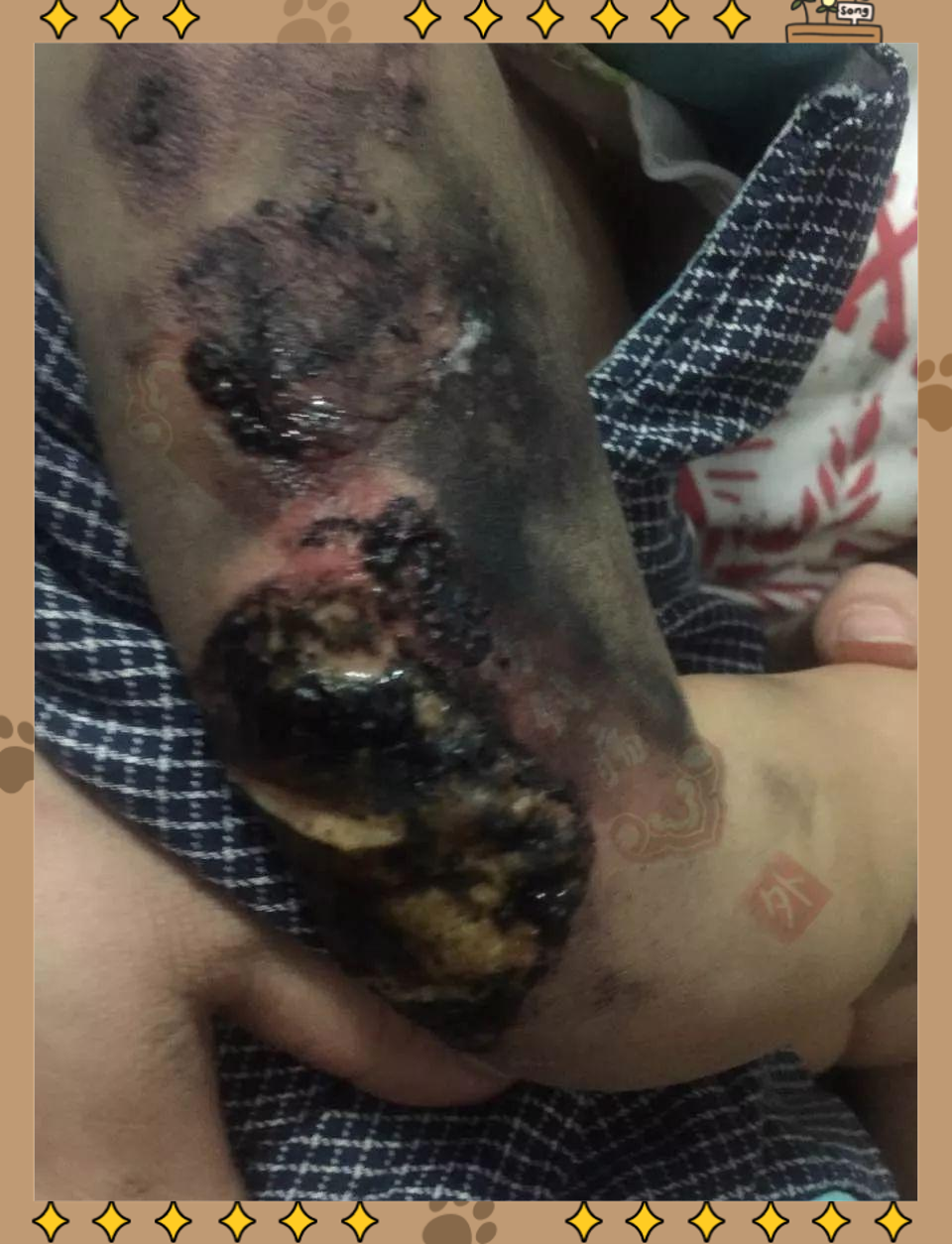 15个月男童烫伤治疗全记录