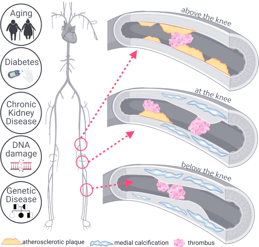外周型血管腔内碎石技术人体研究取得初步成功