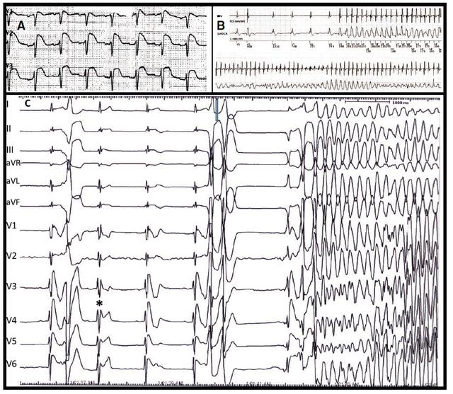 简单三步,明确多形性室速的诊断和紧急治疗