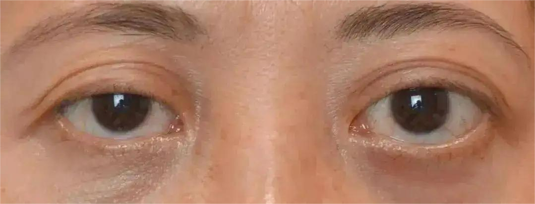双眼皮术后变"青蛙眼"?忽略这4点,术后可能变更丑!