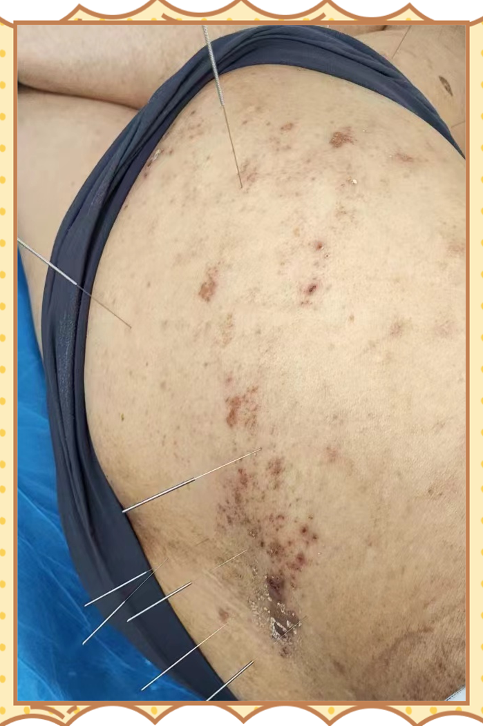 带状疱疹(蛇缠腰)的康复治疗之路