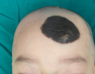 脸上黑斑让6岁女童怕上学医生:黑色素痣可消除