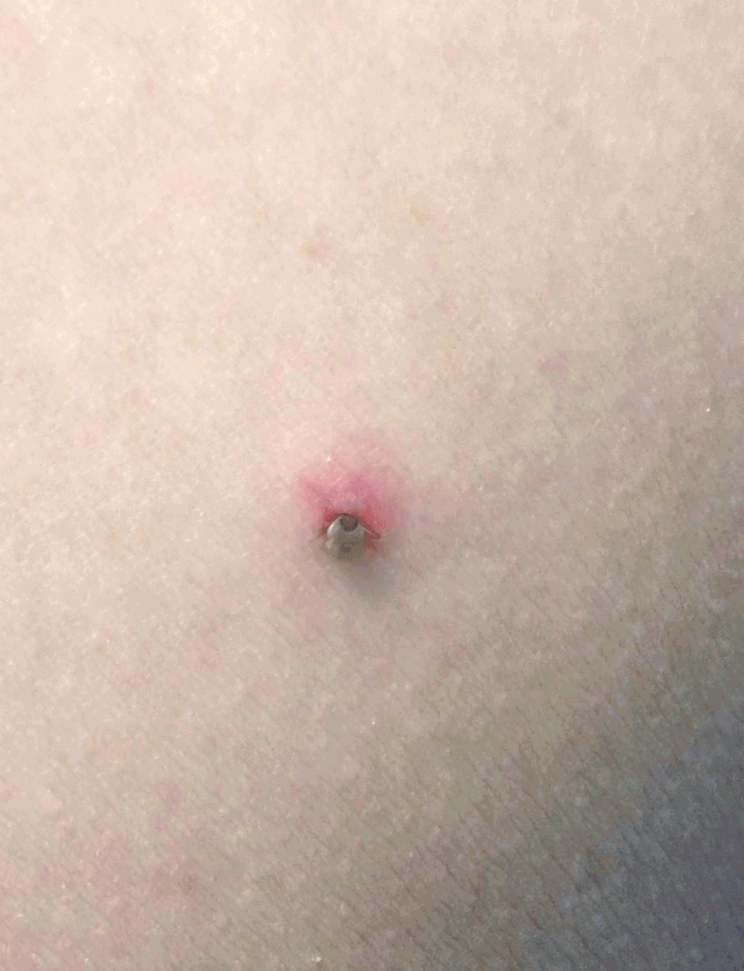 警惕蜱虫叮咬:案例分析与防范措施详解