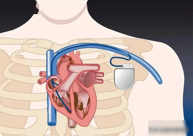 起搏器安放的位置图图片