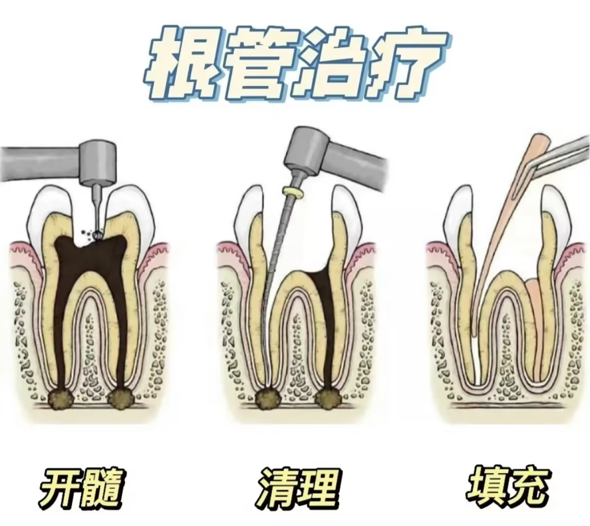 根管治疗多少钱一颗牙图片