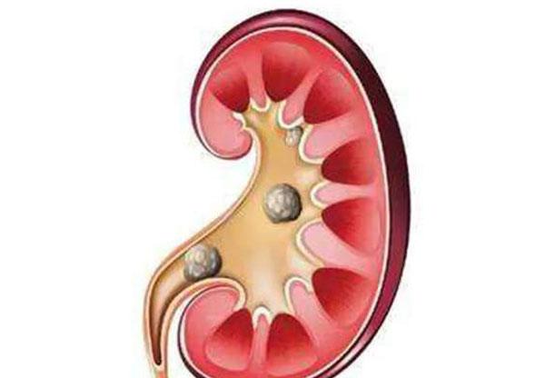 嬰兒腎結石:症狀,原因,預防與治療簡介