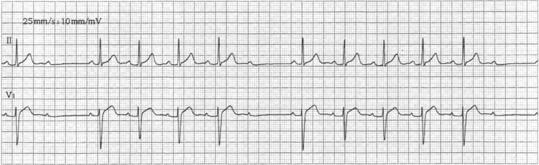 二度ii型房室传导阻滞的心电图表现