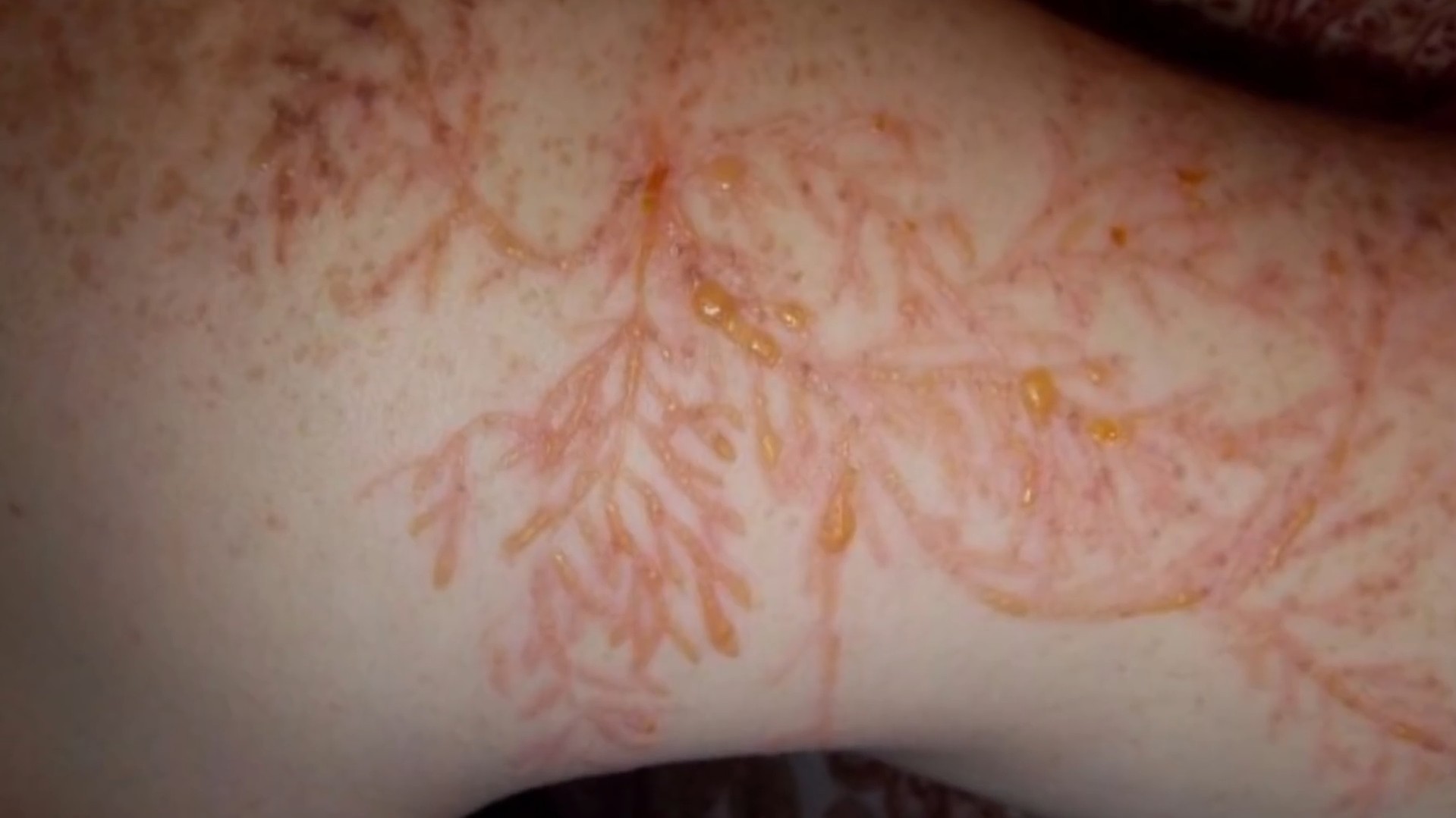 被闪电击中的人都怎么样了?幸存下来的人,有没有所谓的后福呢?